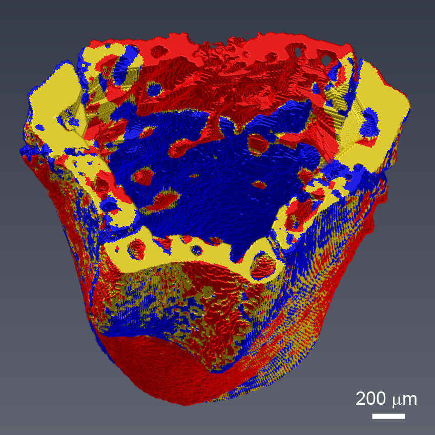 In vivo mouse model of breast cancer bone metastasis showing 4D microcomputed tomography of bone resorption (red), bone formation (blue) and quiescent bone (yellow).